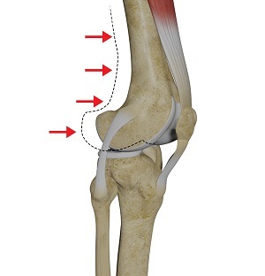 Posterolateral Instability img