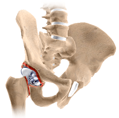Revision Hip Replacement img