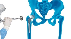 Robotic Total Hip Replacement img