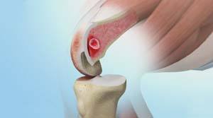 Subchondroplasty img