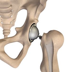 Total Hip Replacement img