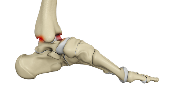 Ankle Impingement images