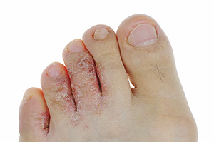 Athletes Foot images