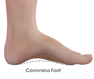 Cavovarus Foot images