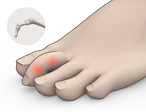 Claw Toe images