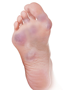 Foot Rheumatoid Arthritis images