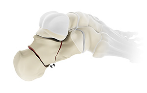 Heel Fracture images
