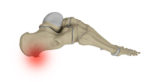 Heel Spurs images