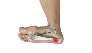 Plantar Fasciitis images