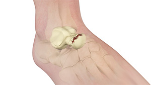 Talus Fracture images