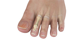 Toe Fracture images