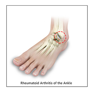 Ankle Rheumatoid Arthritis images