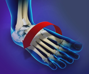 Ankle Instability - Conditions