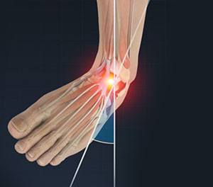 Ankle Sprain - Conditions