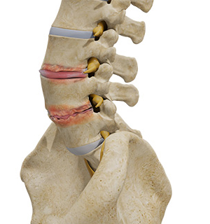 Degenerative Disc Disease - Conditions