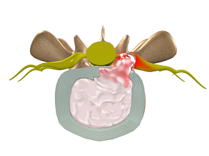 Disc Herniation - Conditions