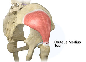 Gluteus Medius Tear - Conditions