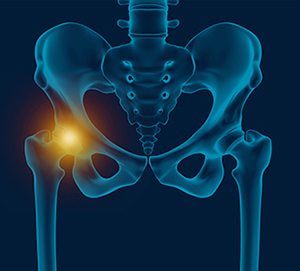 Hip Pain - Conditions