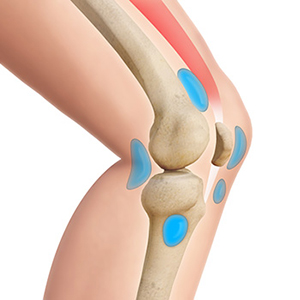 Knee Joint Bursa Infection - Conditions