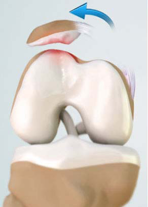 Patellar Dislocation/Patellofemoral Dislocation