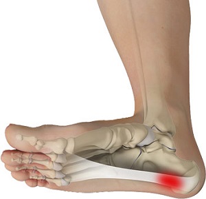Plantar Fasciitis - Conditions