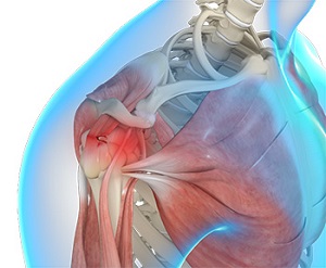 Rotator Cuff Tear - Conditions