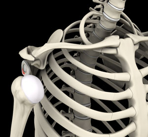 Shoulder Instability - Conditions