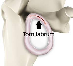 Shoulder Labral Tear - Conditions