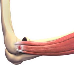 Tennis Elbow - Conditions