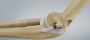 Ulnar Collateral Ligament Injuries - Conditions