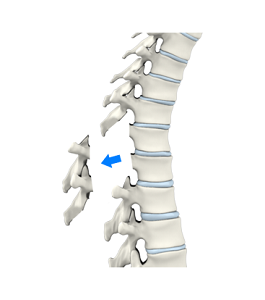 Laminectomy Img