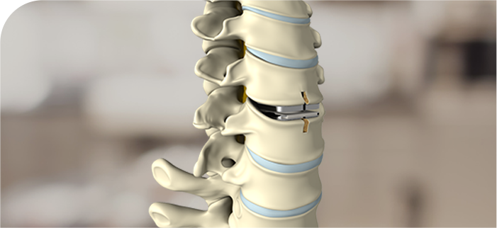 Disc Replacement Services