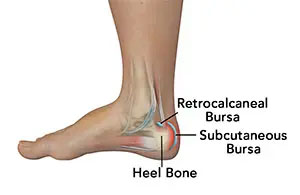 Achilles Tendon Bursitis