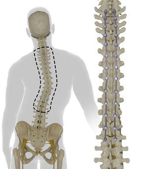 Spinal Curve Correction