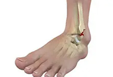 Picture of Ankle Fractures