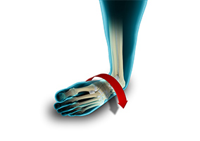 Picture of Ankle Instability