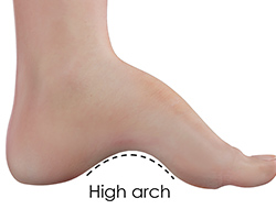 Picture of Cavus Foot Deformity