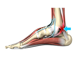 Picture of Tarsal Tunnel Syndrome