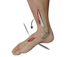 Picture of Tendon Transfer