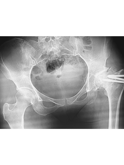 S/p Failed Pinning After Scooter Scroll Images 2