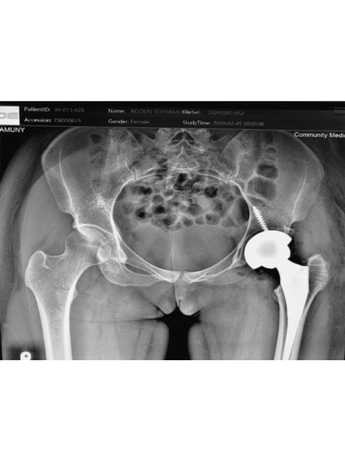 S/p Failed Pinning After Scooter Scroll Images 3