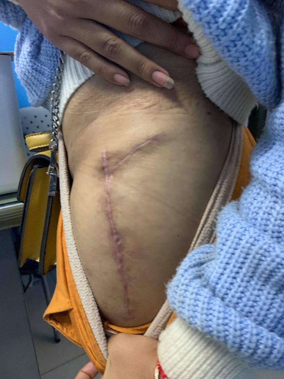 Giant cell Tumor Images 1