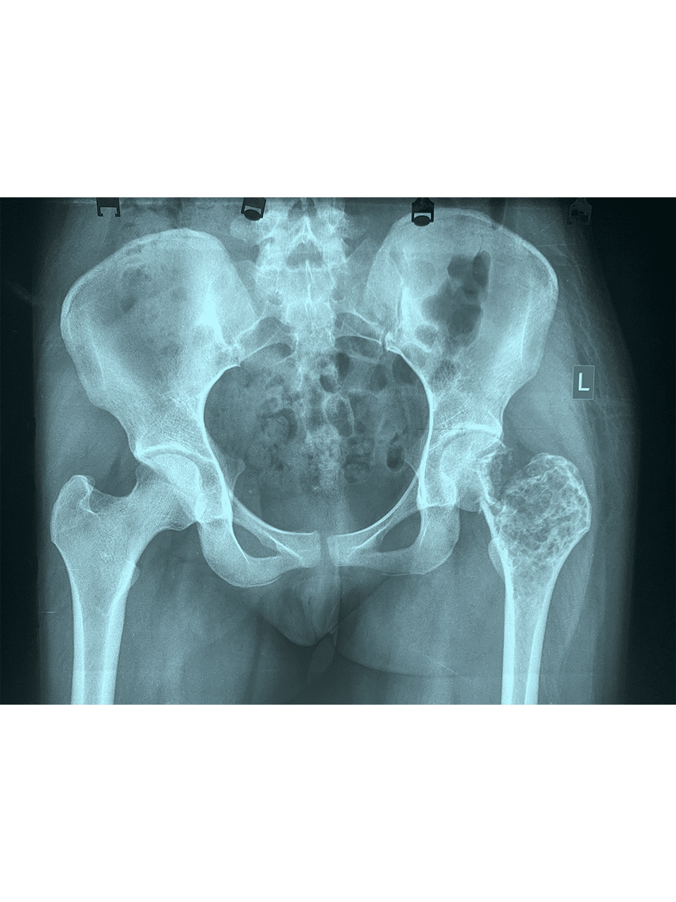 Giant cell Tumor Images 12