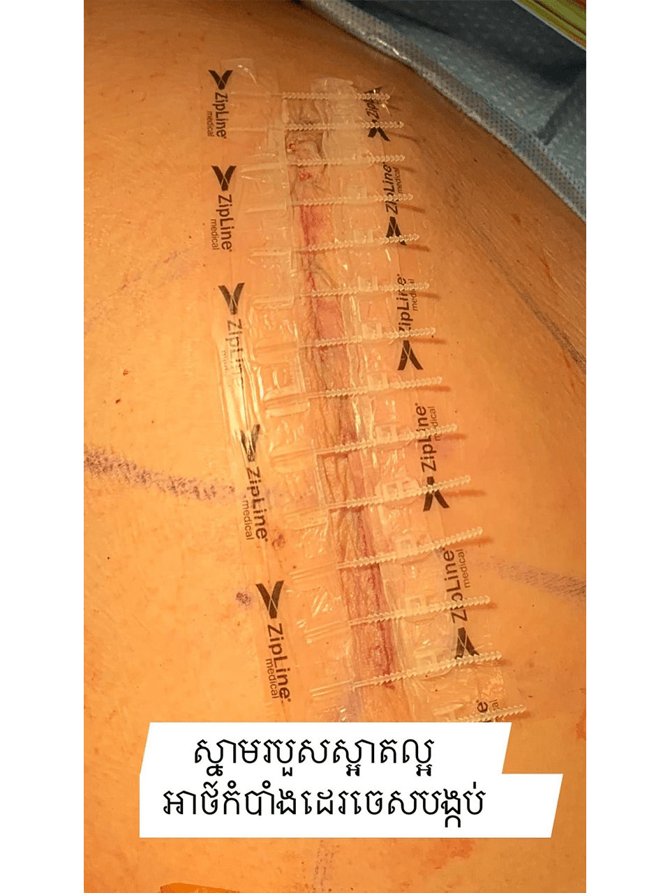 Giant cell Tumor Images 3