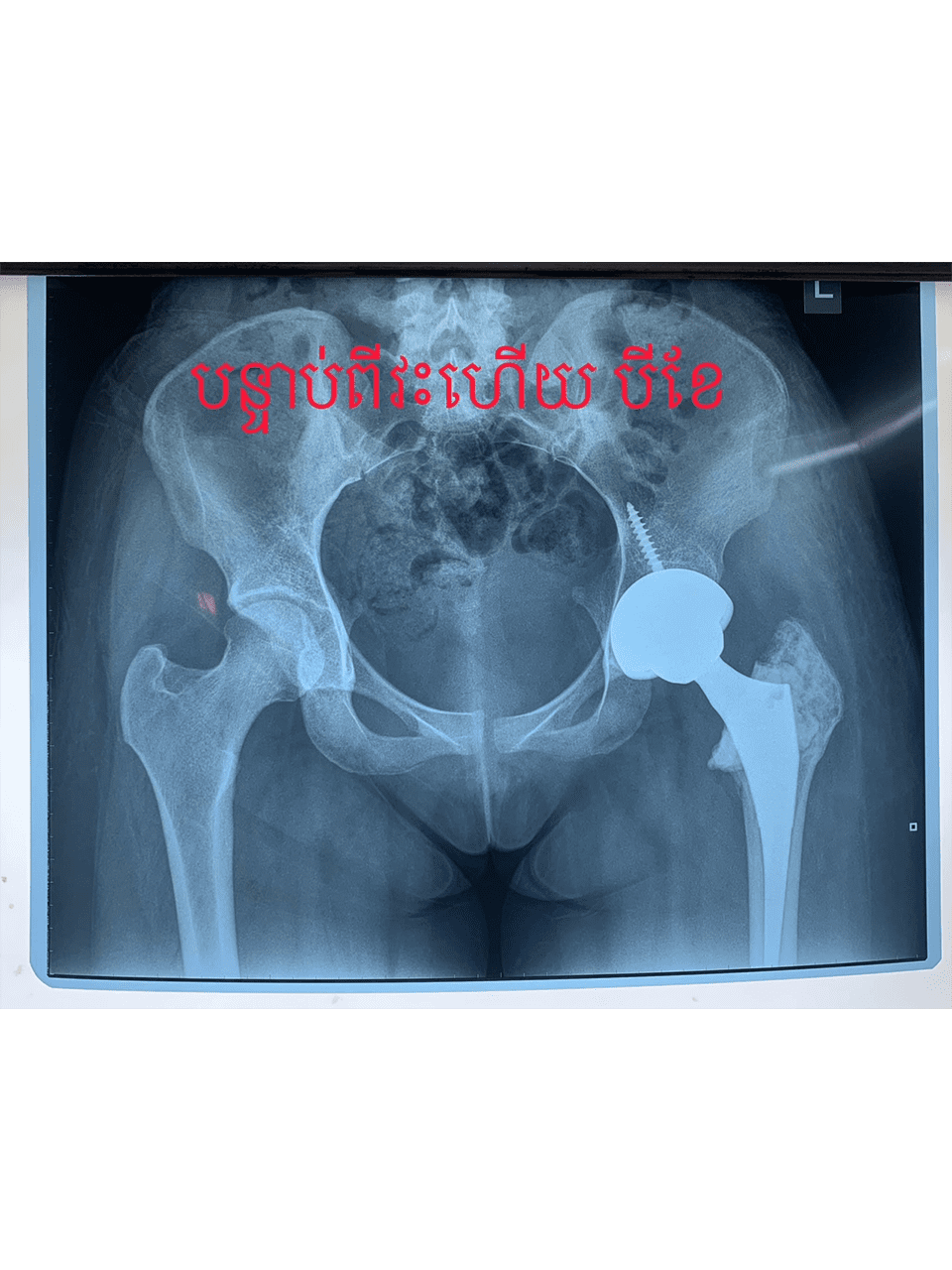 Giant cell Tumor Images 5