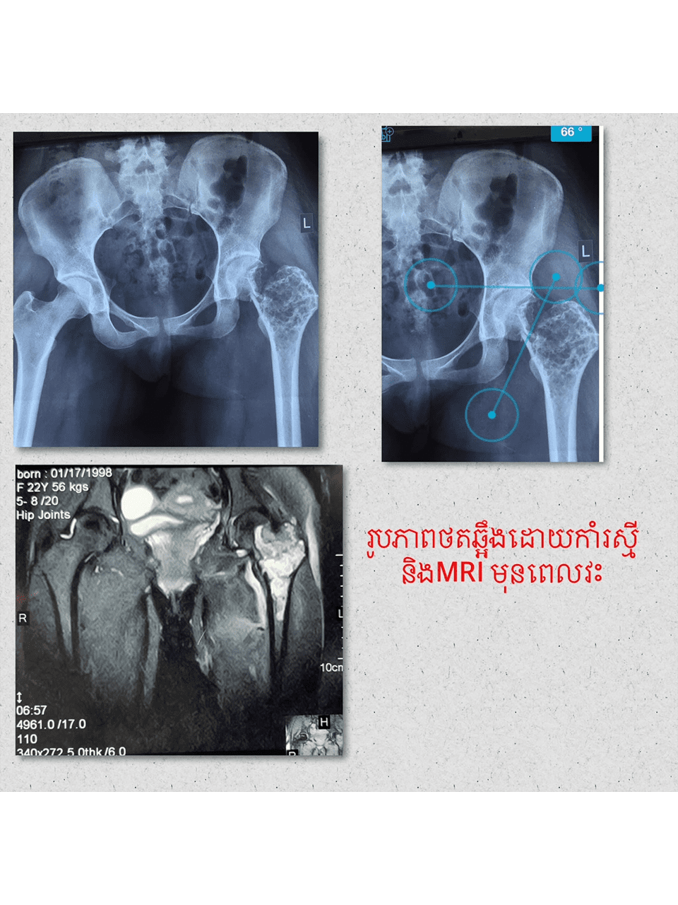 Giant cell Tumor Images 6