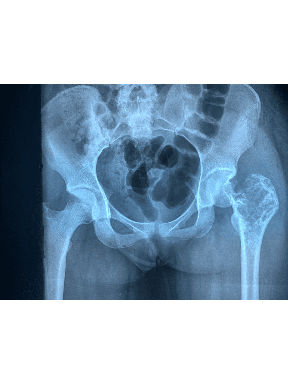 Giant cell Tumor Images 9