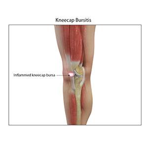  Kneecap Bursitis Pic