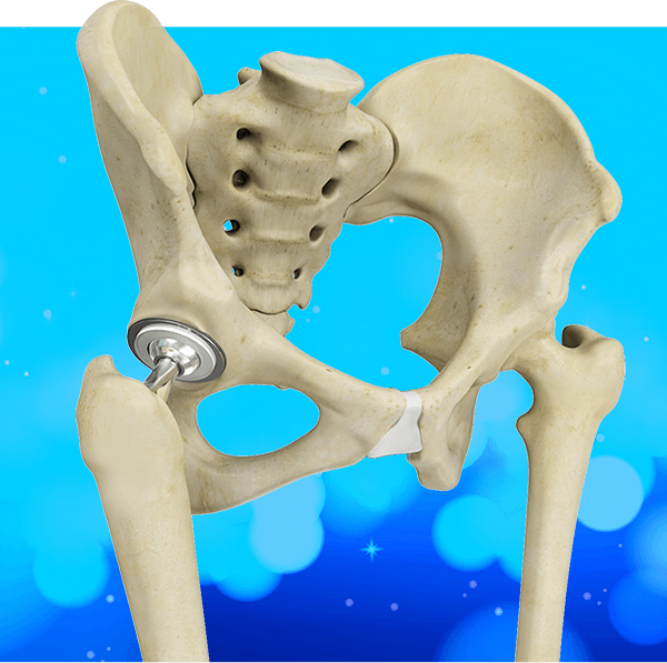 Total Hip Replacement