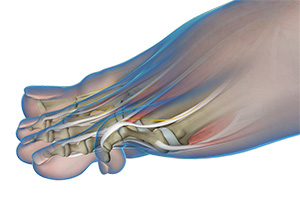 Hammer Toe images